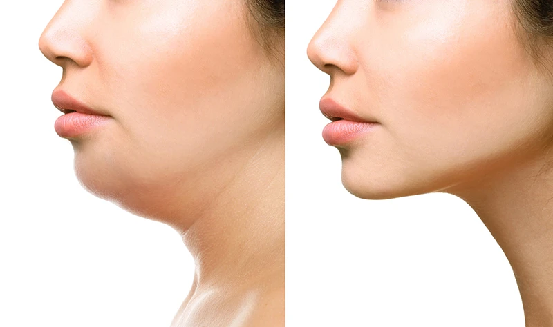 Kybella injections