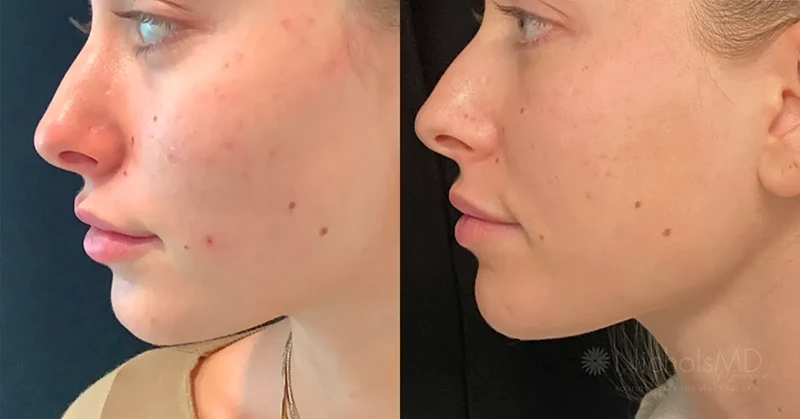 Vampire Facial before and after